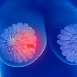 Falta de acesso a mamógrafos limita prevenção do câncer de mama